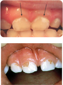 Dental Conditions in Children